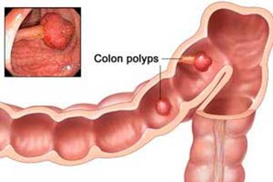 Colonicpolyps