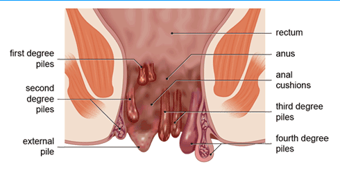 Piles-haemorrhoids