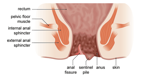 anal-fissure