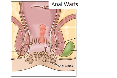 anal-warts