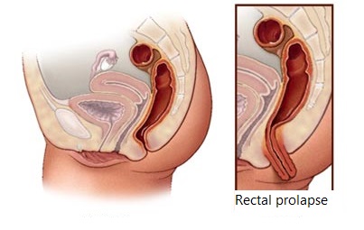 rectal prolapse